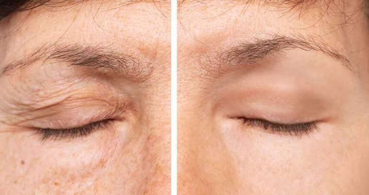 Blefaroplastia cirúrgica